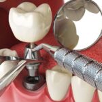 Dent Implant Clinic in Korea: Affordable and Advanced Dental Care
