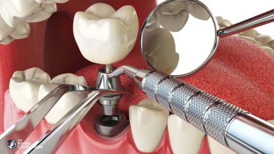 Dent Implant Clinic in Korea Affordable and Advanced Dental Care